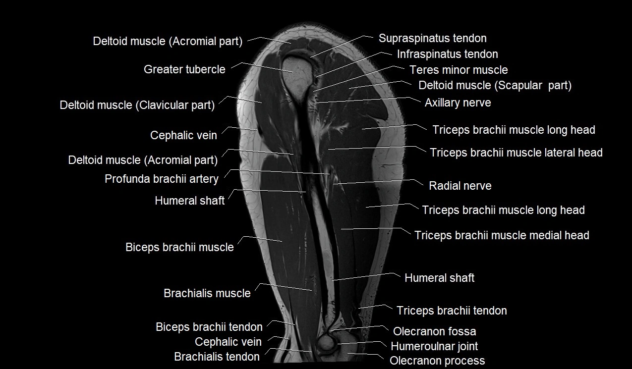 Upper arm (humerus ) saittal cross sectional anatomy 3T image 14.webp
